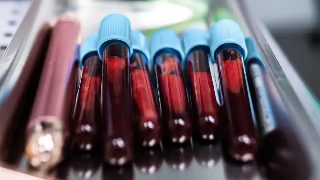 Test tečne biopsije može omogućiti brže praćenje terapije raka dojke