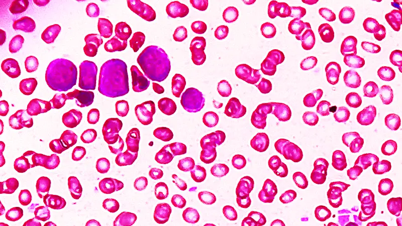 Kako je nanotehnologija učinila stari lek za leukemiju 22.000 puta jačim