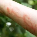 Osip od otrovnog bršljana: simptomi, lečenje i prevencija